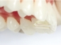 Preview: Replacement tips for Tiger Dental MiniMold (palatal bite block)