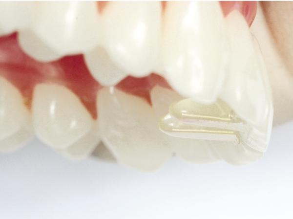 Replacement tips for Tiger Dental MiniMold (palatal bite block)